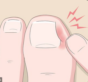 Alicate Profissional para Desencravar Unhas